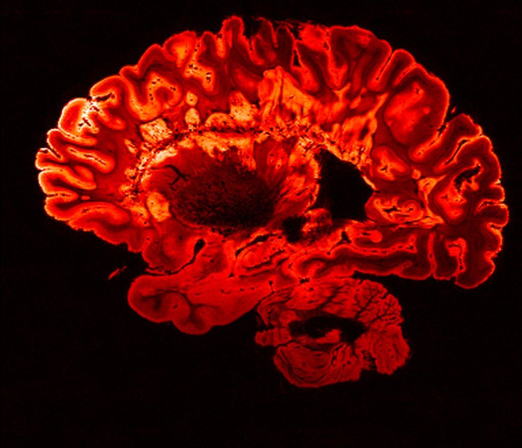 Colourised MRI scan of a human brain, in orange on black