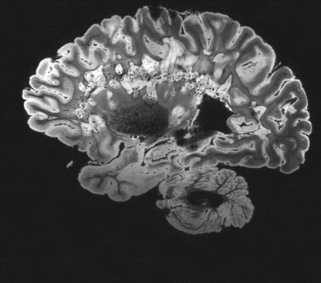 Greyscale MRI scan of a human brain